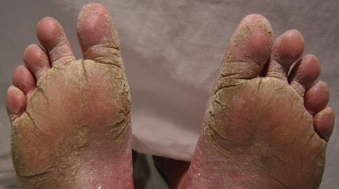 Aloe Vera Gel for Athletes Foot