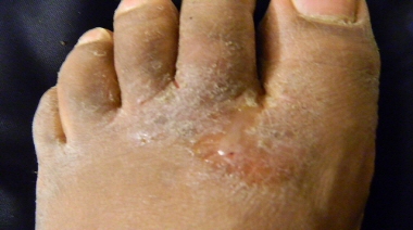Aloe Vera Gel to Help Athletes Foot