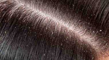 Aloe Vera Gel for Dandruff and Baldness