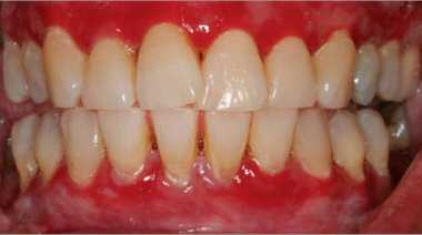 Aloe Vera Gel for Gingivitis