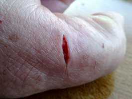 Thumb knife cut cleaned with water and teatree day 1