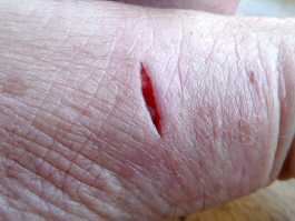 Thumb knife cut healed with aloe gel day 2