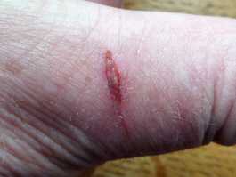 Thumb knife cut healed with aloe gel day 4
