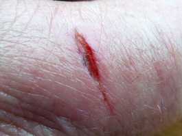 Thumb knife cut healed with aloe gel day 6