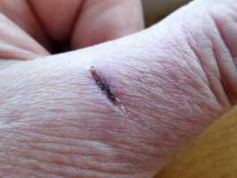 Thumb knife cut healed with aloe gel day 10
