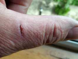 Thumb knife cut healed with aloe gel day 11